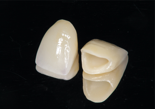 オールセラミックのかぶせ物